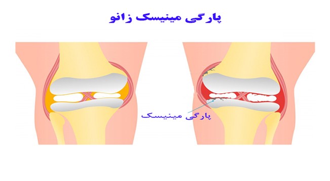 پارگی مینیسک زانو