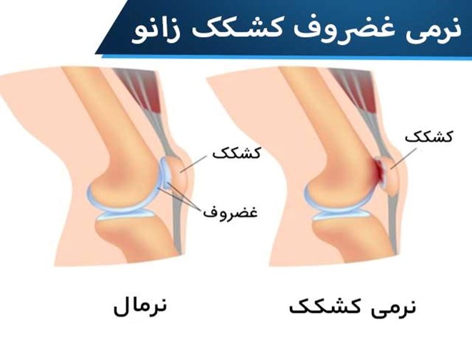 نرم شدن غضروف زیرین و میانی کشکک زانو